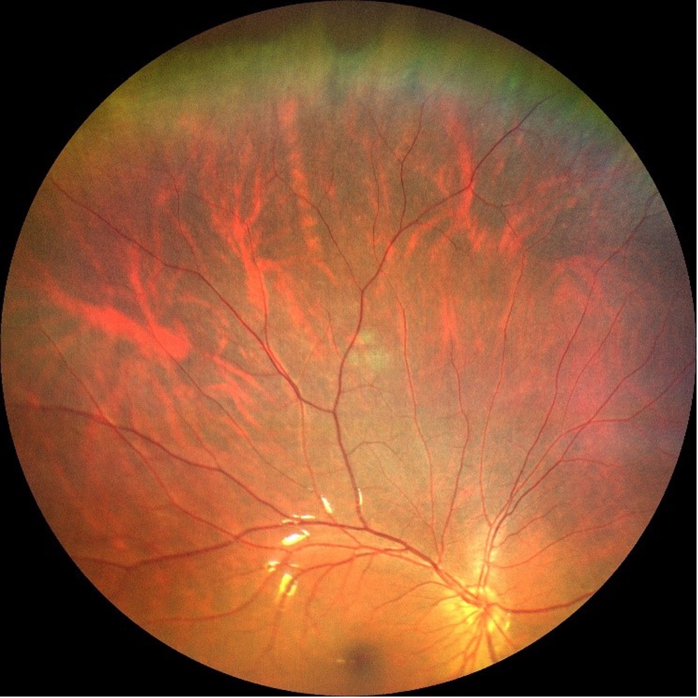 ZEISS CLARUS 500 ultra-wide field image captures peripheral retinal in a myopic eye. 