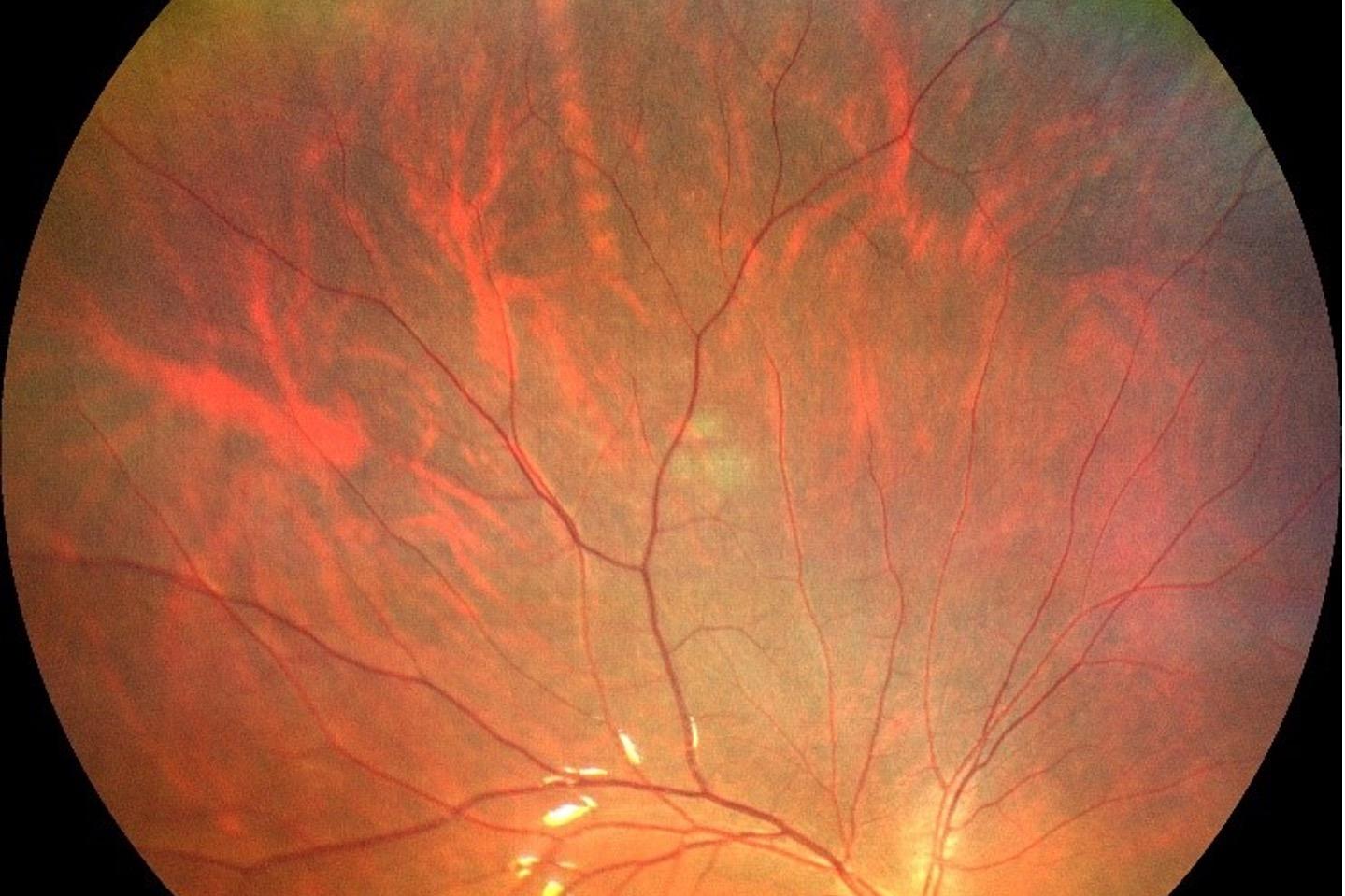ZEISS CLARUS 500 ultra-wide field image captures peripheral retinal in a myopic eye. Orra serrata structures with dentate processes and meridional folds are viewable.