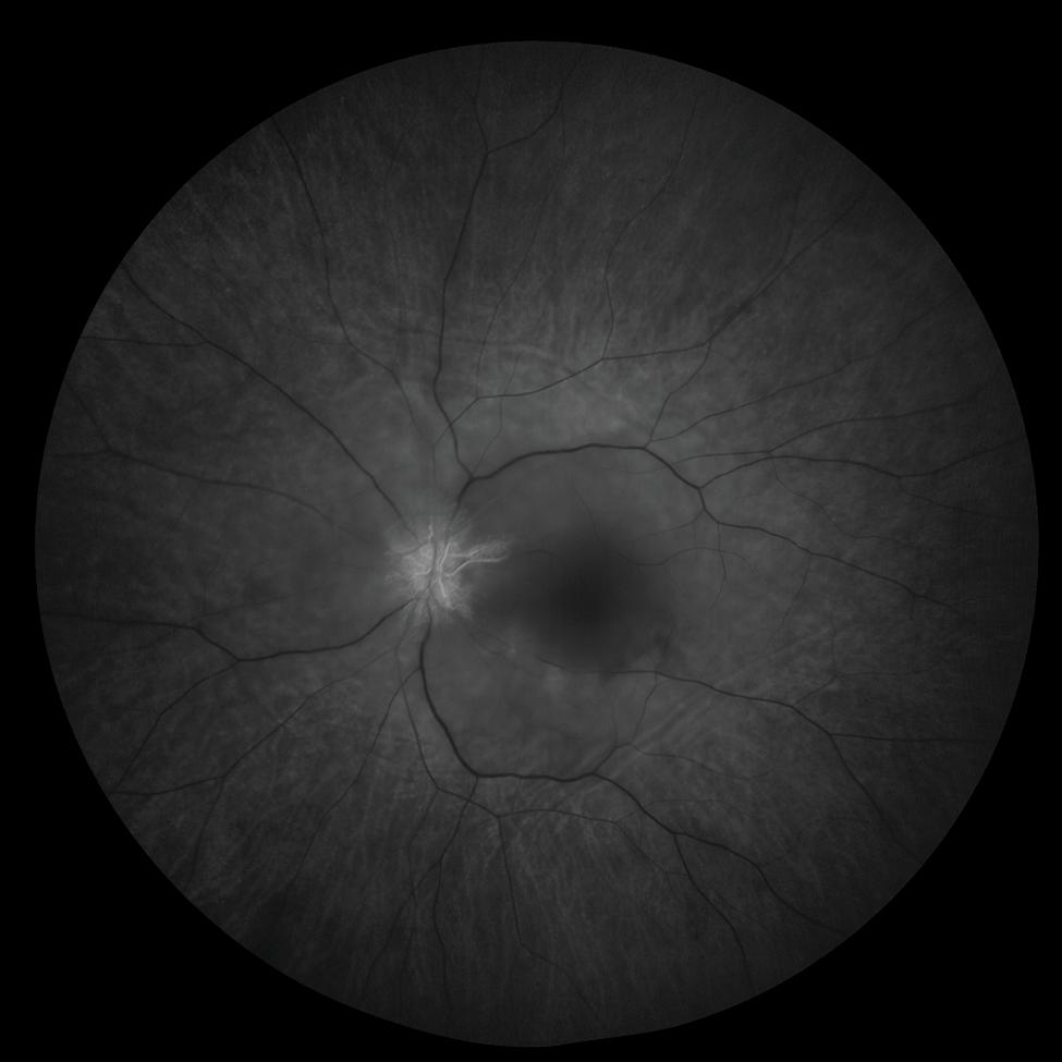 Central Retinal Artery Occlusion OS (CRAO)