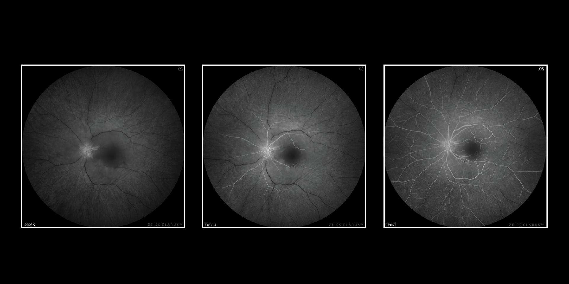 Central Retinal Artery Occlusion OS (CRAO) Fluorescein Angiography (FA) Widefield