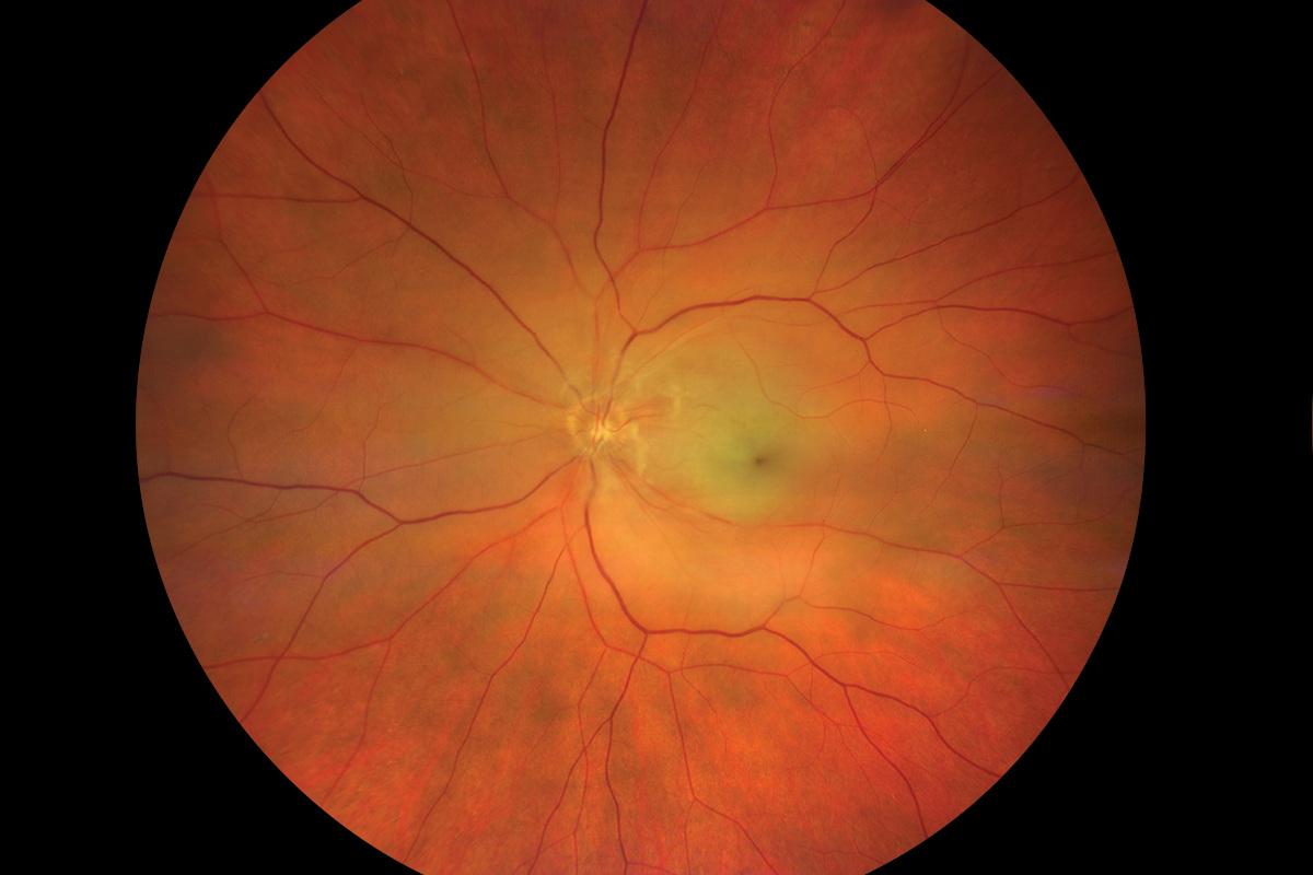 Central Retinal Artery Occlusion OS (CRAO) True Color Widefield