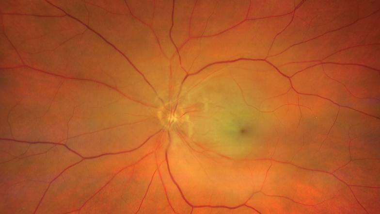 Central Retinal Artery Occlusion OS (CRAO) Case 3 [63-yr old female]