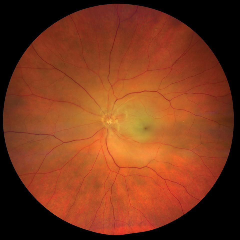 Central Retinal Artery Occlusion OS (CRAO) True Color Widefield