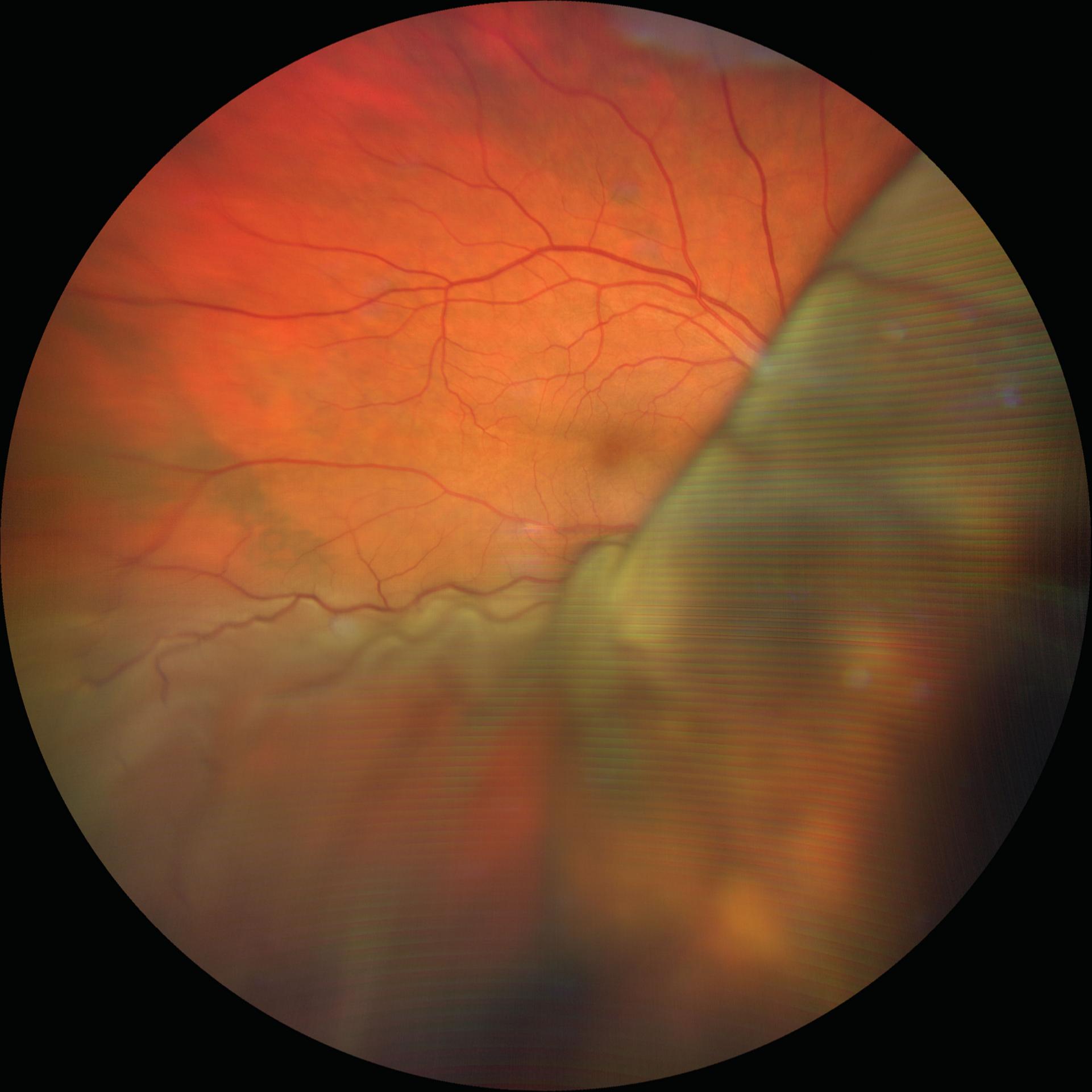 Choroidal Melanoma True Color and Fluorescein Angiography (FA) Widefield 