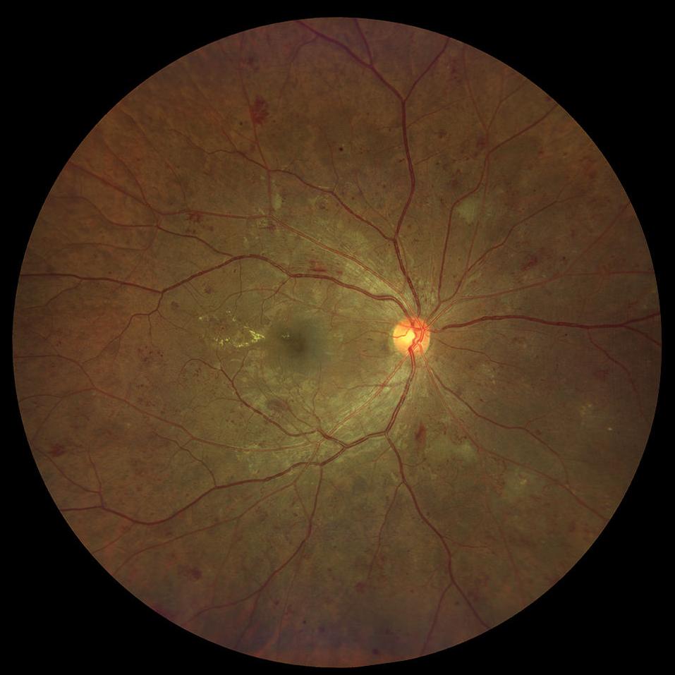 Intraretinal microvascular abnormalities True Color Widefield 