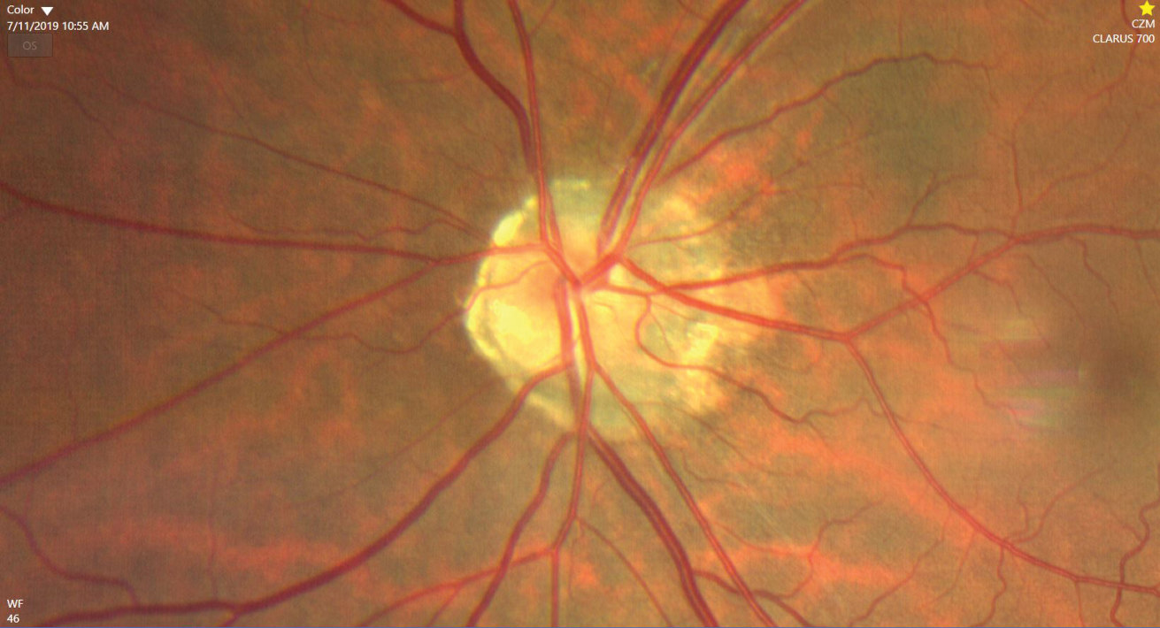 Optic Nerve Drusen
