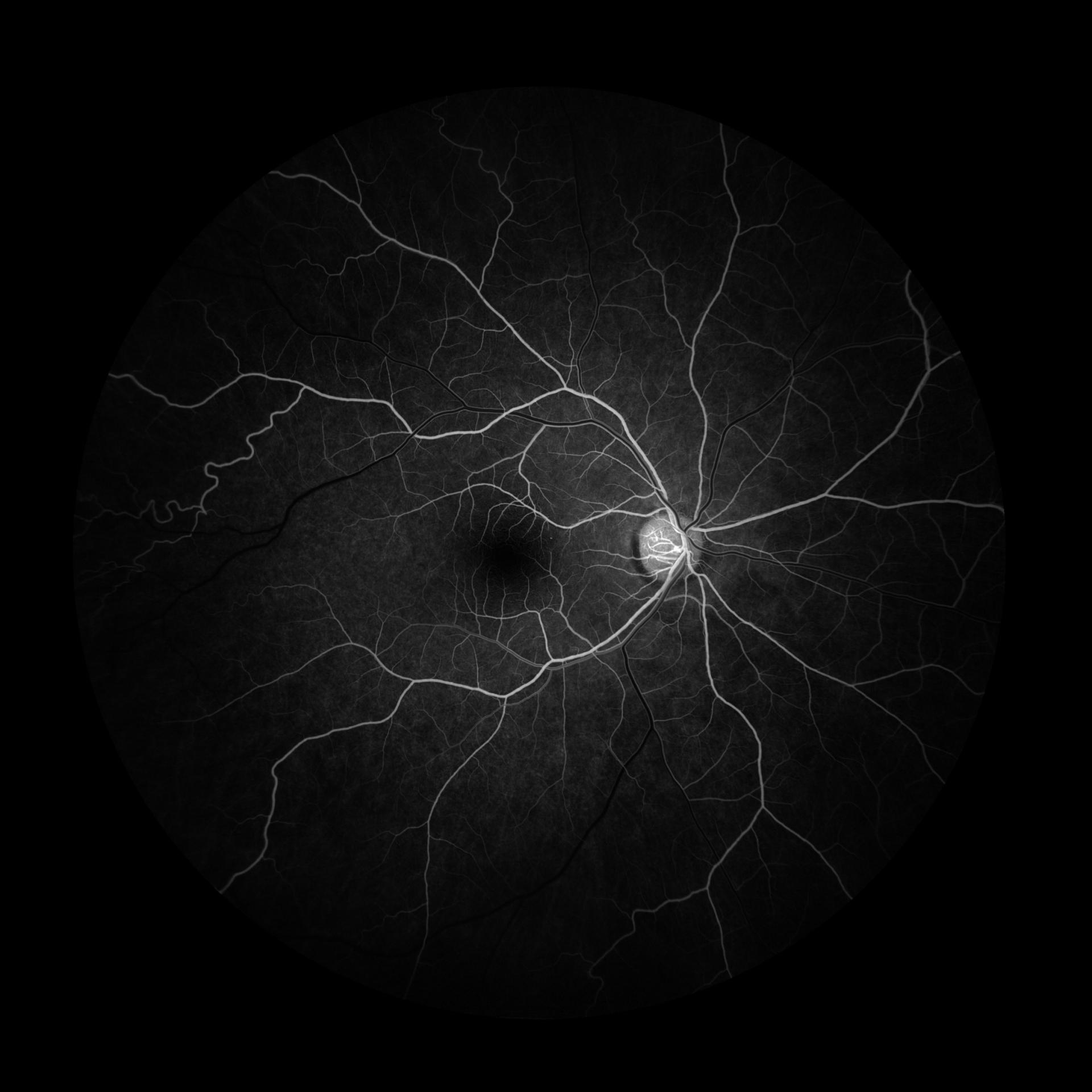 Sickle Cell Retinopathy