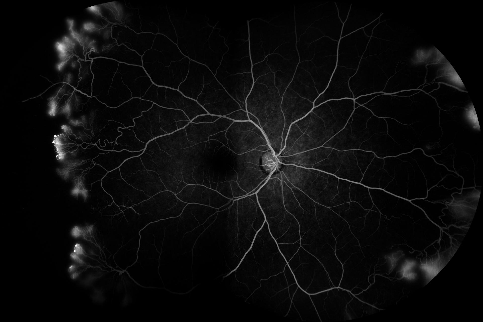 Fluorescein angiography reveals extensive sea-fan neovascularization in the peripheral retina