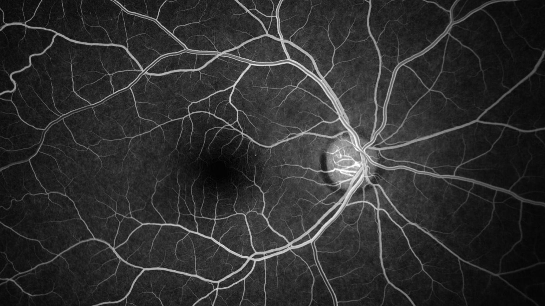 Sickle Cell Retinopathy Case 9 [38-yr old male]