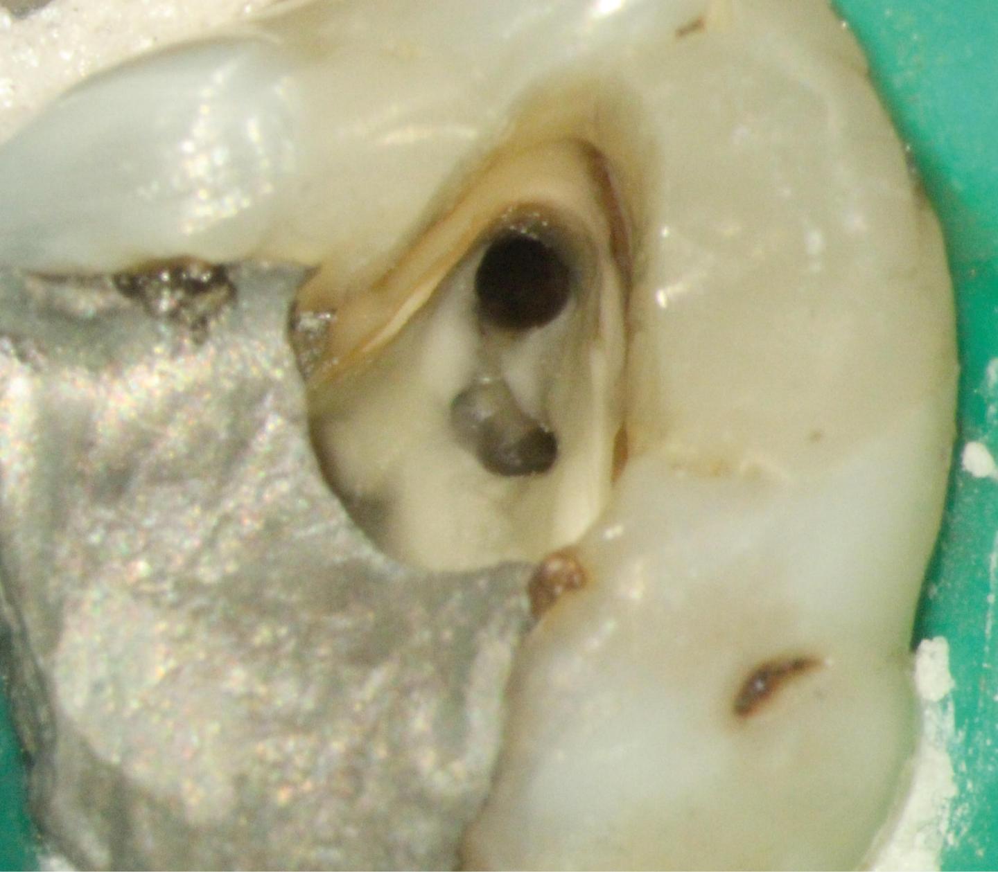 Microindentation Tooth Microdentistry in Endodontics