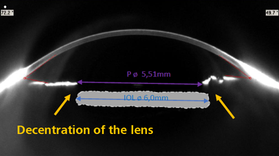Decentration of IOLs