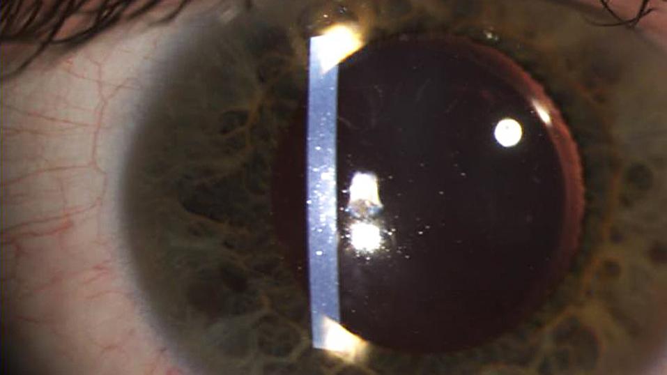 Image of a Slit lamp examination