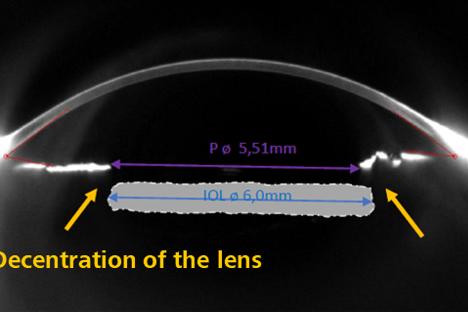 Decentration of IOLs