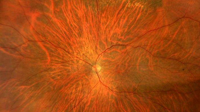 Ultra-widefield (UWF) of Retinal Tear