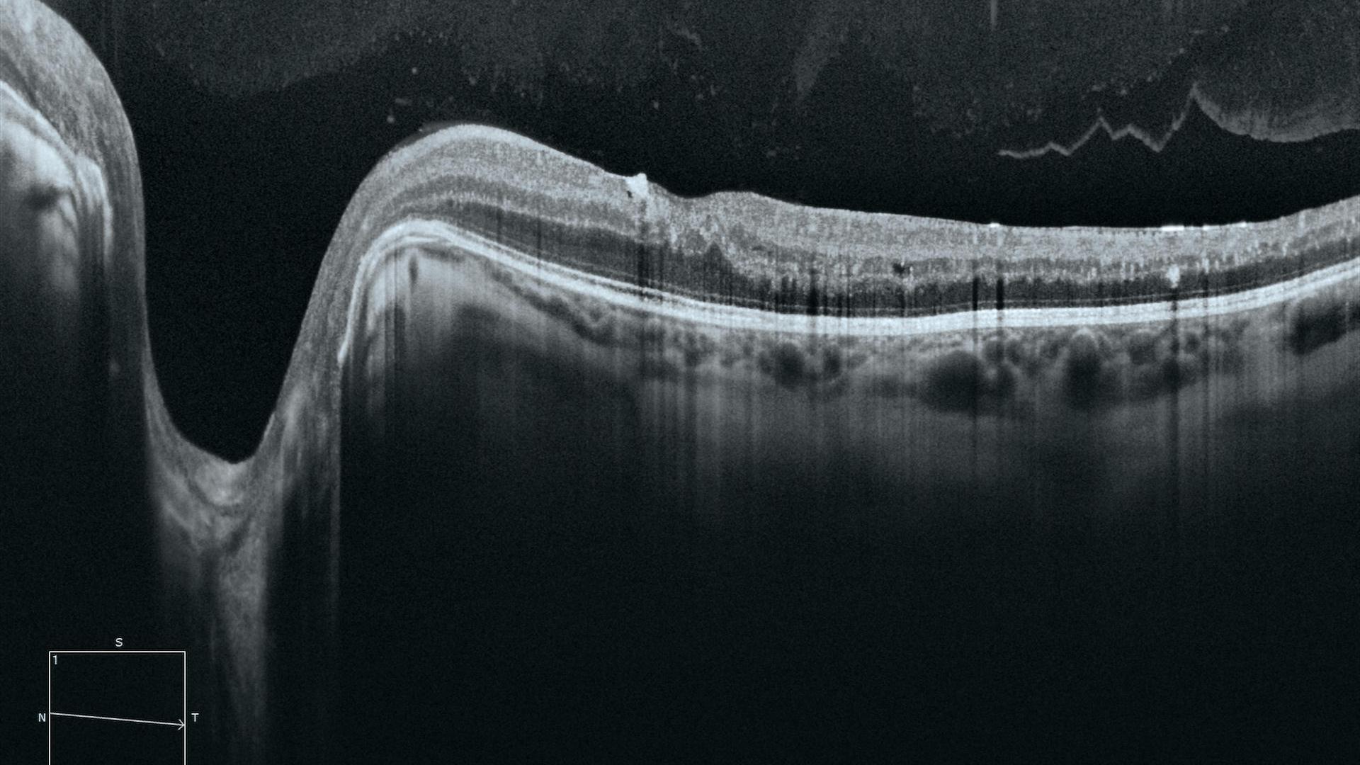 Advanced Imaging: Seeing Beyond with AI: ZEISS CIRRUS 6000 & ZEISS CLARUS 700