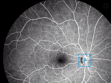 ZEISS CLARUS