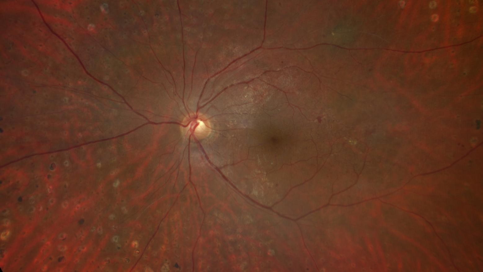 Fundus image of a human retina showing the optic nerve head, macula, and blood vessels captured with ZEISS diagnostic imaging technology.