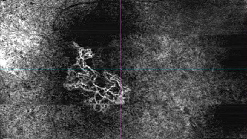 ZEISS medical imaging software interface displaying detailed retinal scans with analysis tools and comparison views.