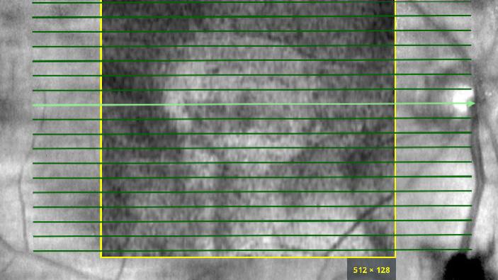 Screenshot of ZEISS medical imaging software displaying eye scan results