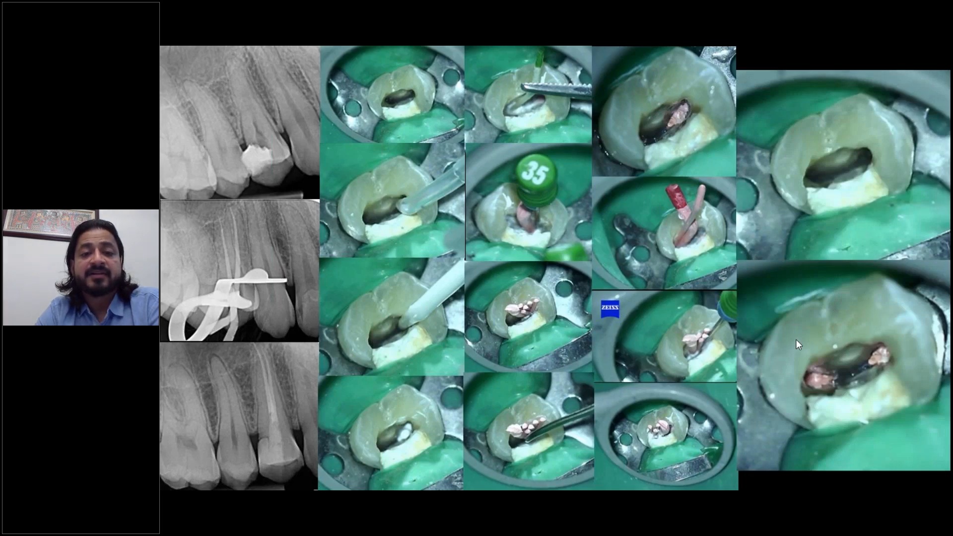 Vergrößerung in der Endodontie: Notwendigkeit vs. Fantasie