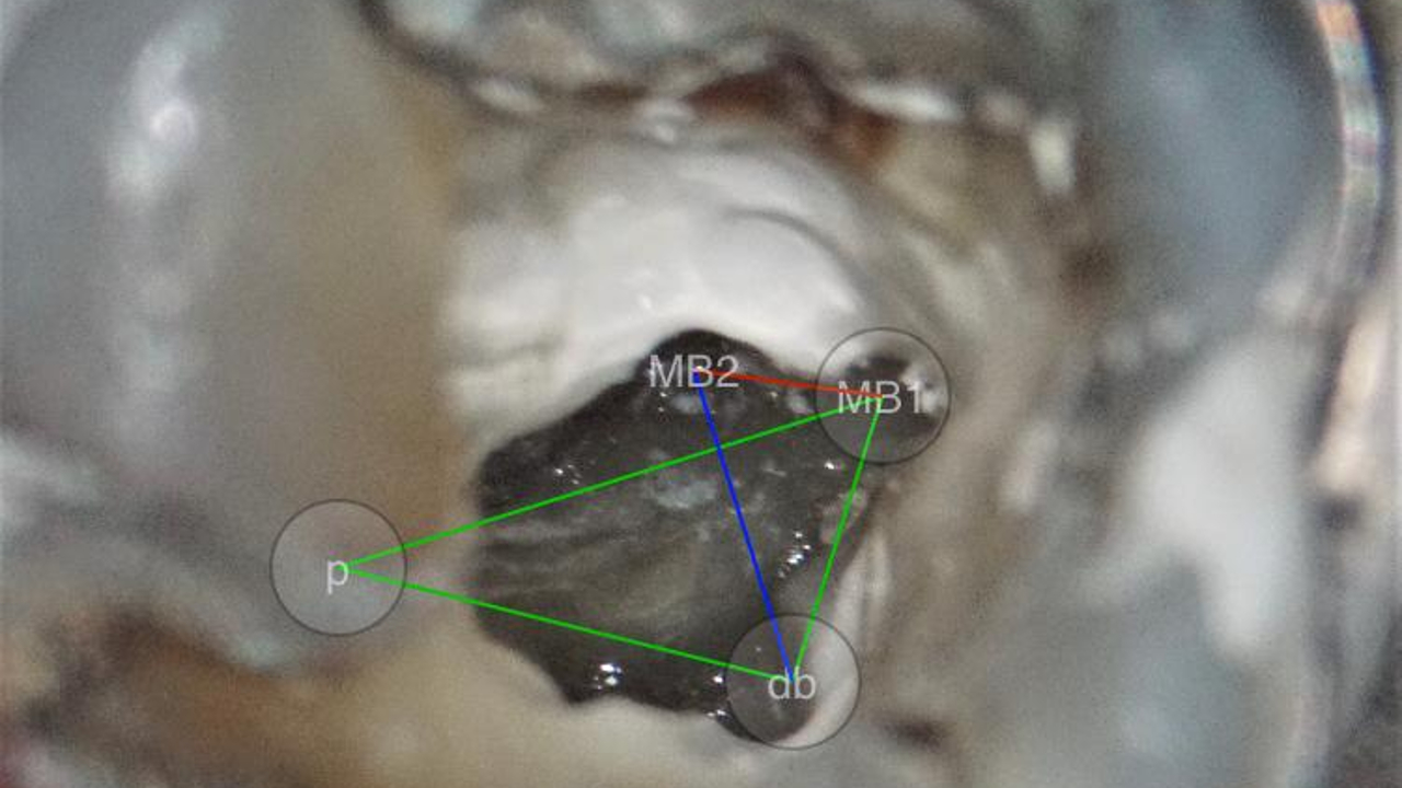 The Visualisation and Management of Calcified Canals