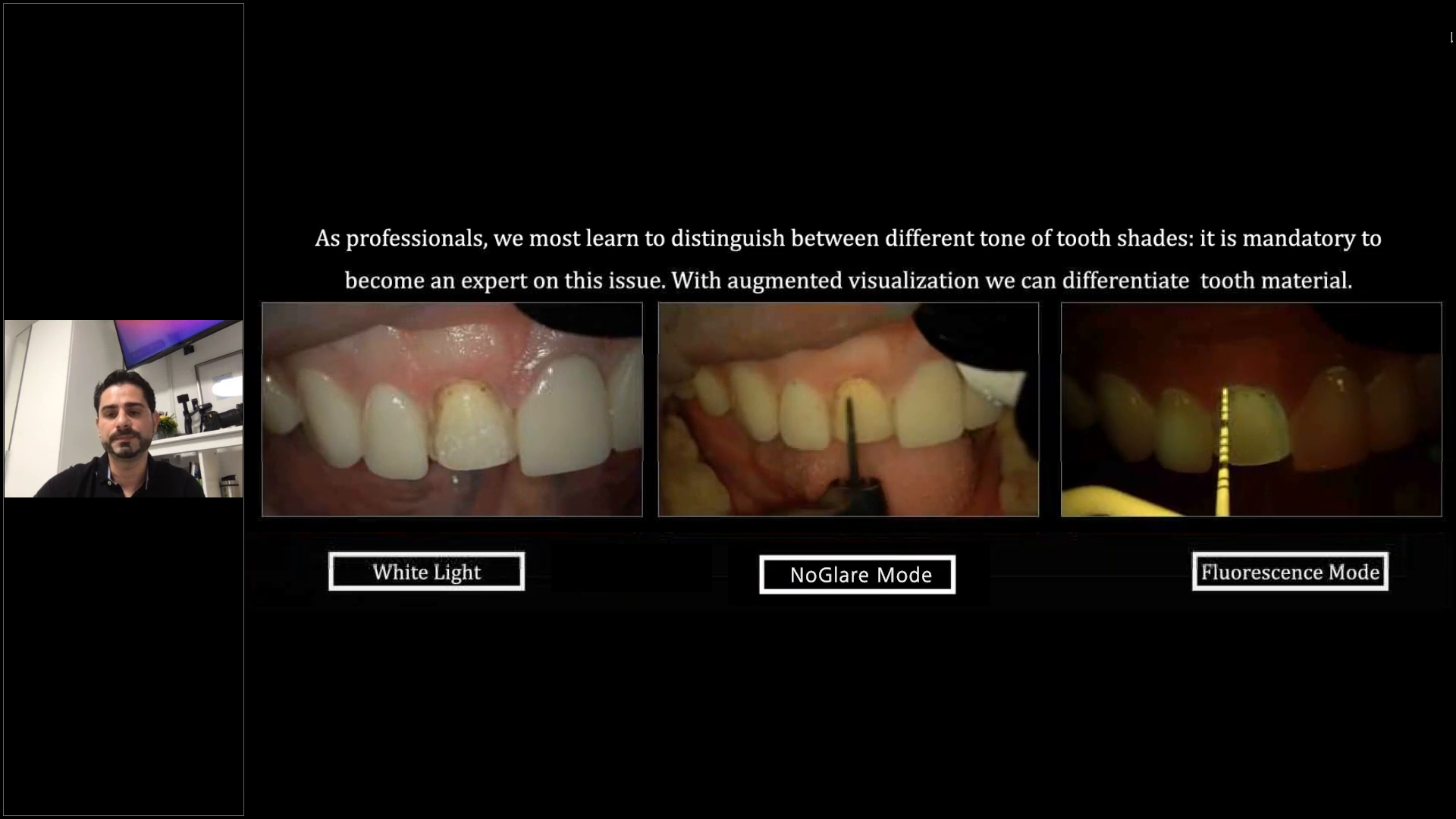 Microscopic approach of an indirect restoration