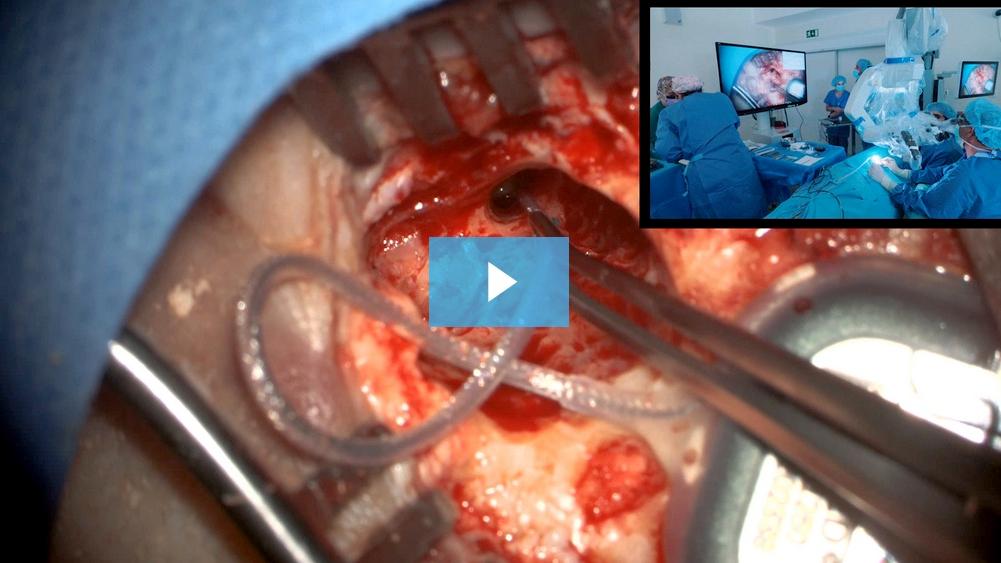 Cirurgia de implante coclear consecutivo para perda auditiva bilateral