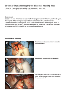 Pré-visualizar imagem de Cochlear implant surgery for bilateral hearing loss