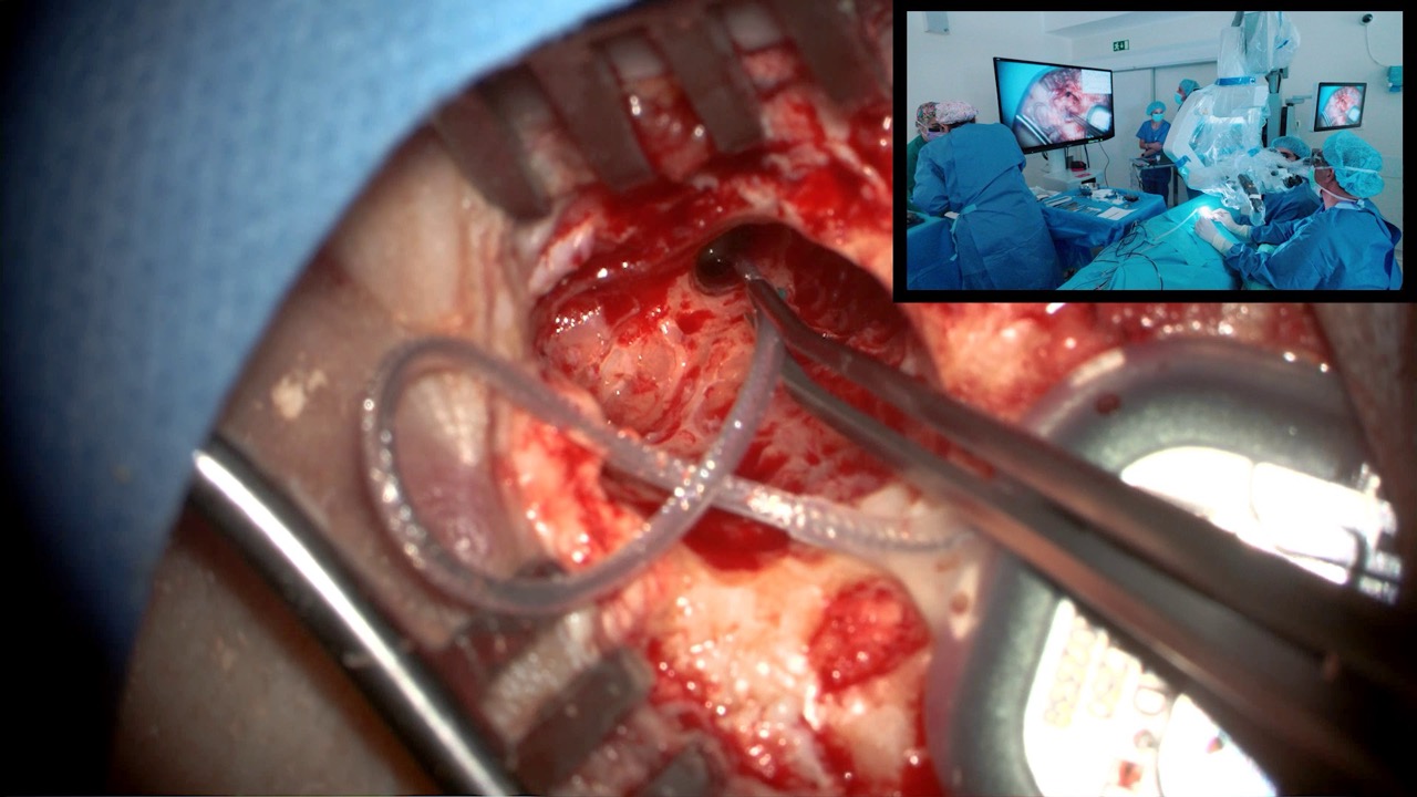 Cochlear implant surgery for bilateral hearing loss