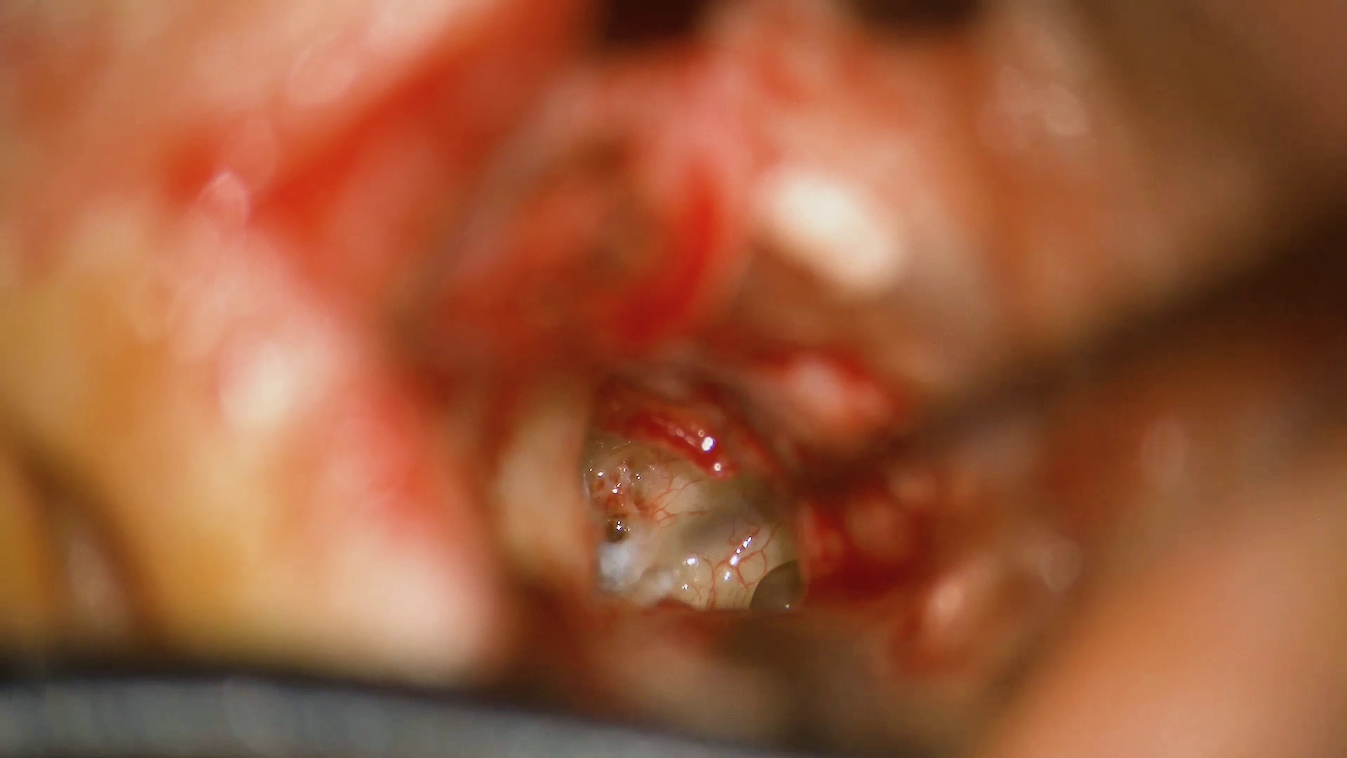 Revision stapes surgery for severe to profound conductive hearing loss
