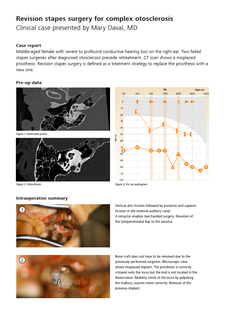 Pré-visualizar imagem de Revision stapedotomy for profound conductive hearing loss with ZEISS TIVATO 700