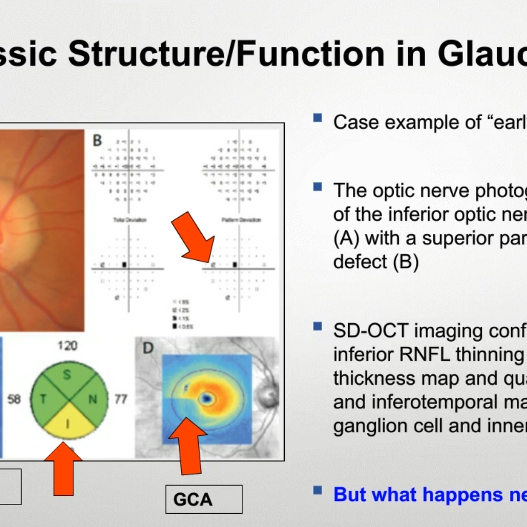 Glaucoma Oct Dataset