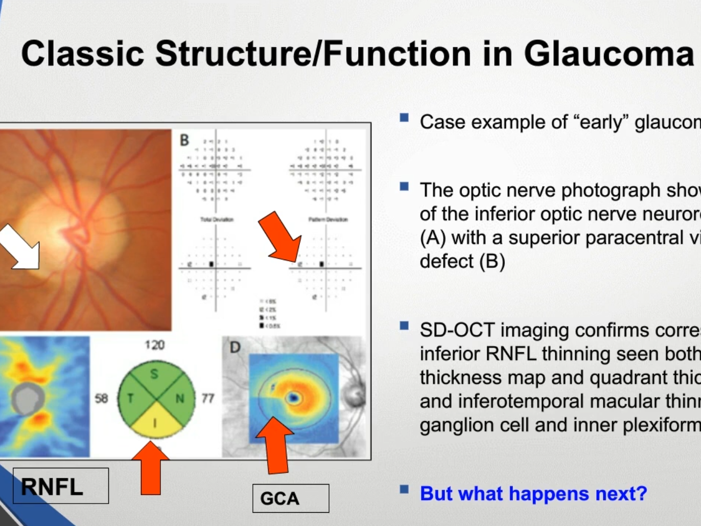 Glaucoma Oct Results