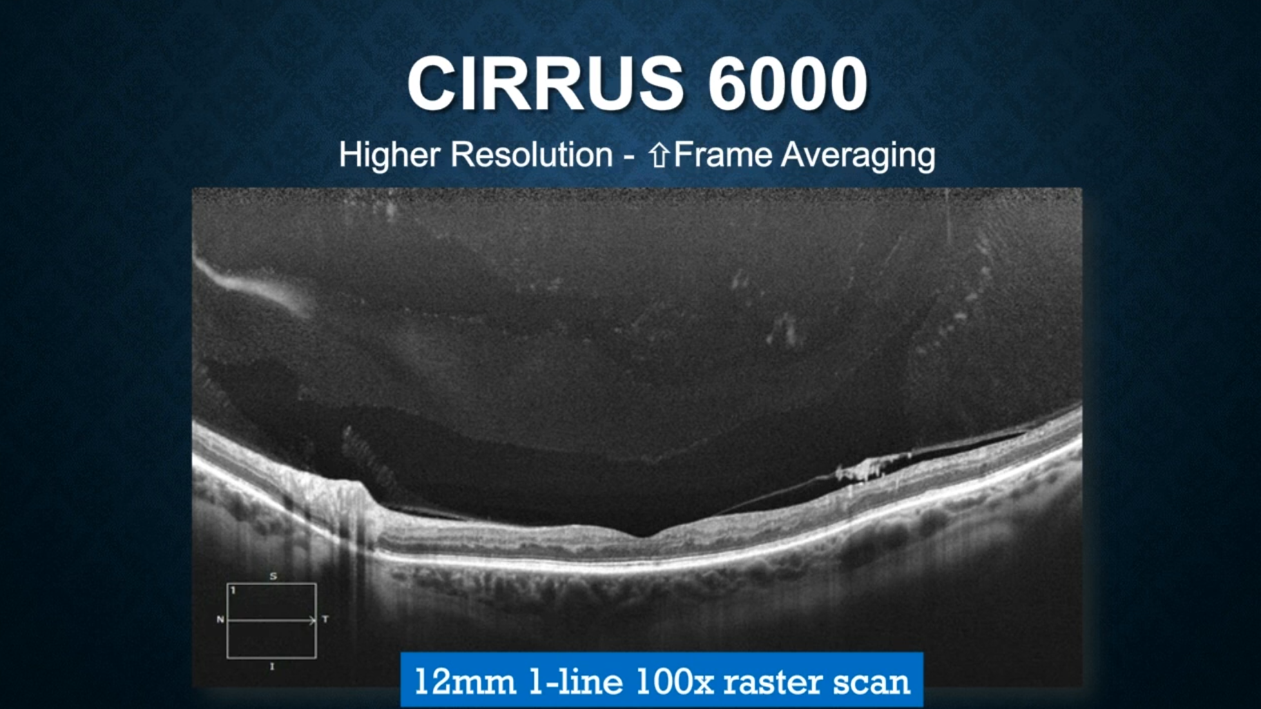 Latest in OCT technology for retinal disease management