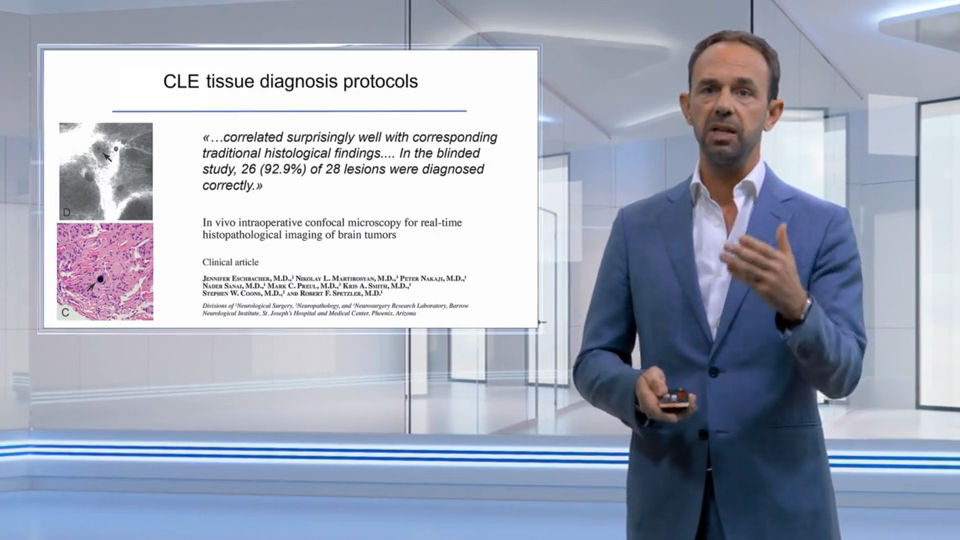 Endomicroscopie confocale laser chez des patients atteints de tumeurs intracrâniennes dans une zone difficile d'accès