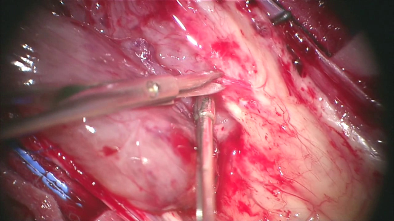 Ampliação em endodontia: necessidade vs. fantasia
