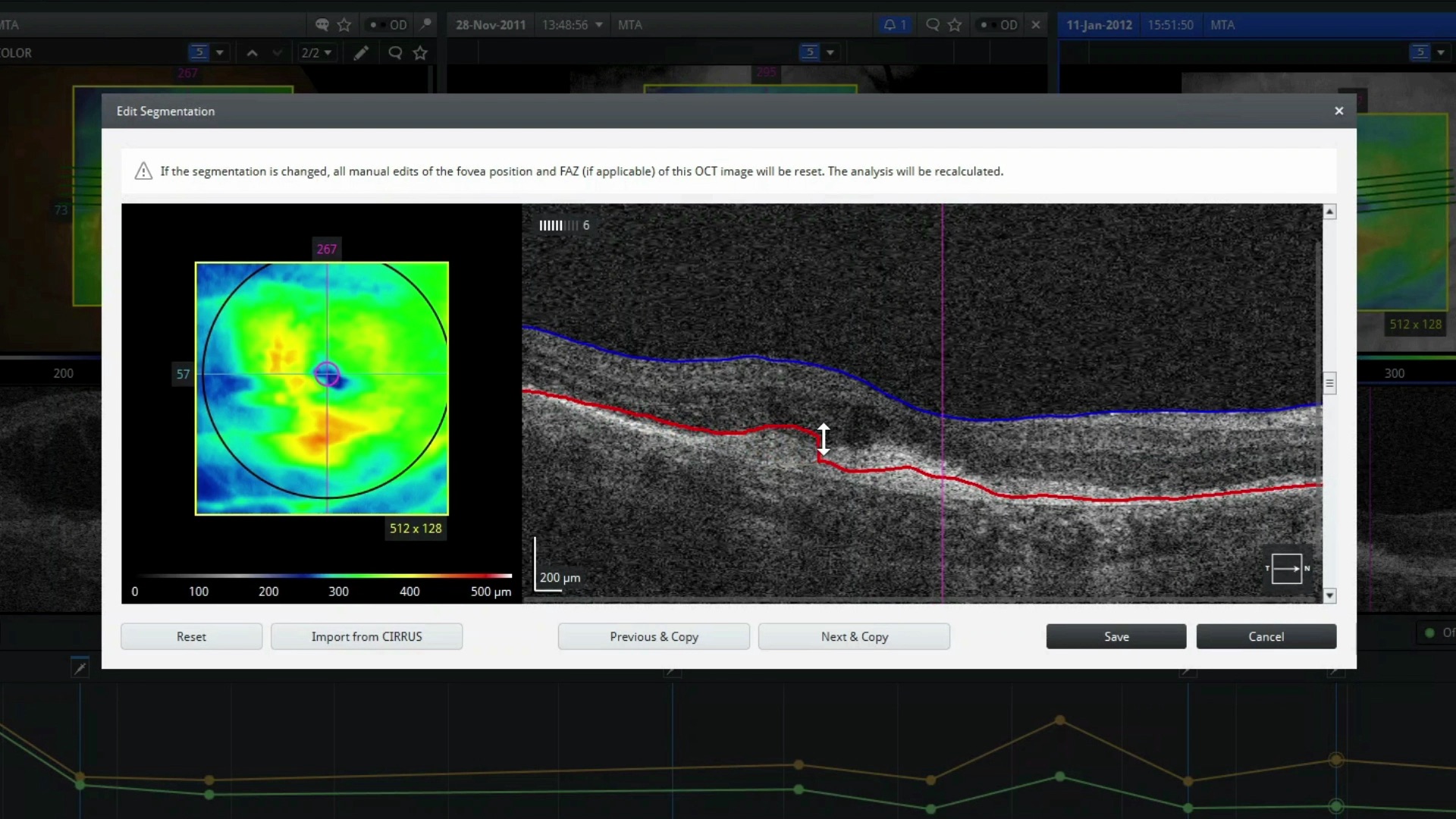 En 30 segundos: Cómo usar la edición de líneas de segmentación en ZEISS Retina Workplace