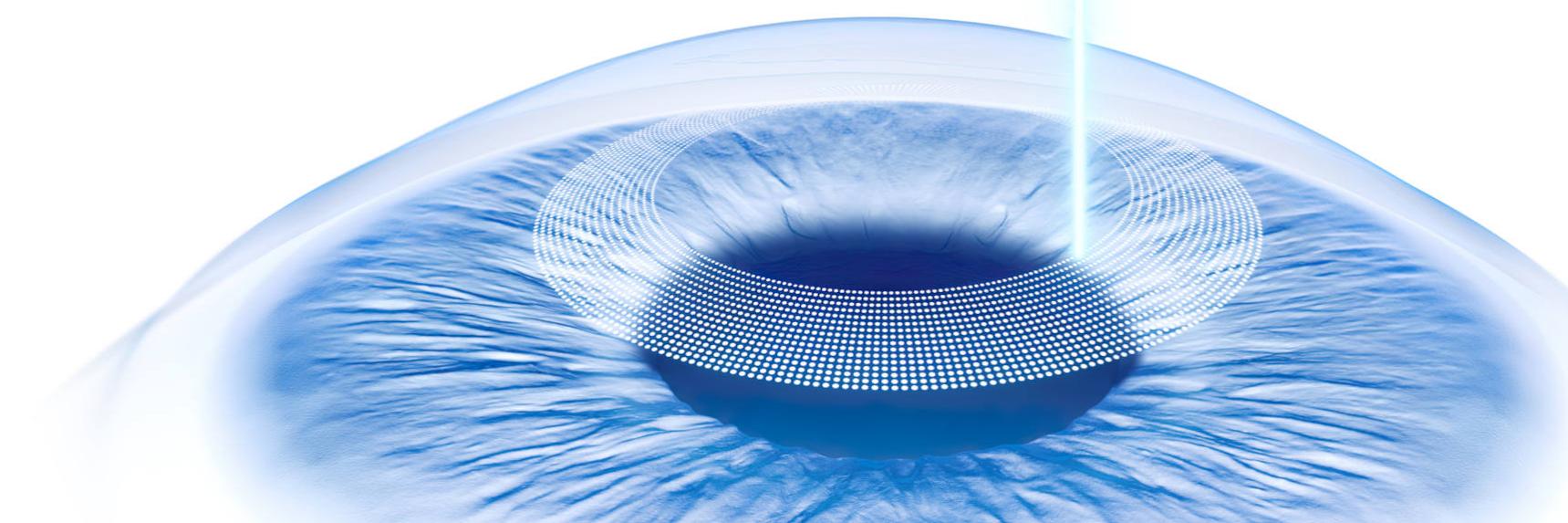 Key image Corneal Refractive