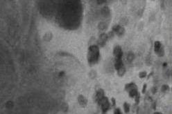 Patient diagnostiqué avec un méningiome fibroblastique