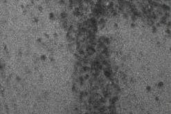 Glioblastome récurrent