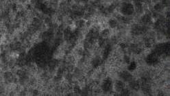 Glioblastome, grade OMS IV