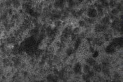 Glioblastome, grade OMS IV