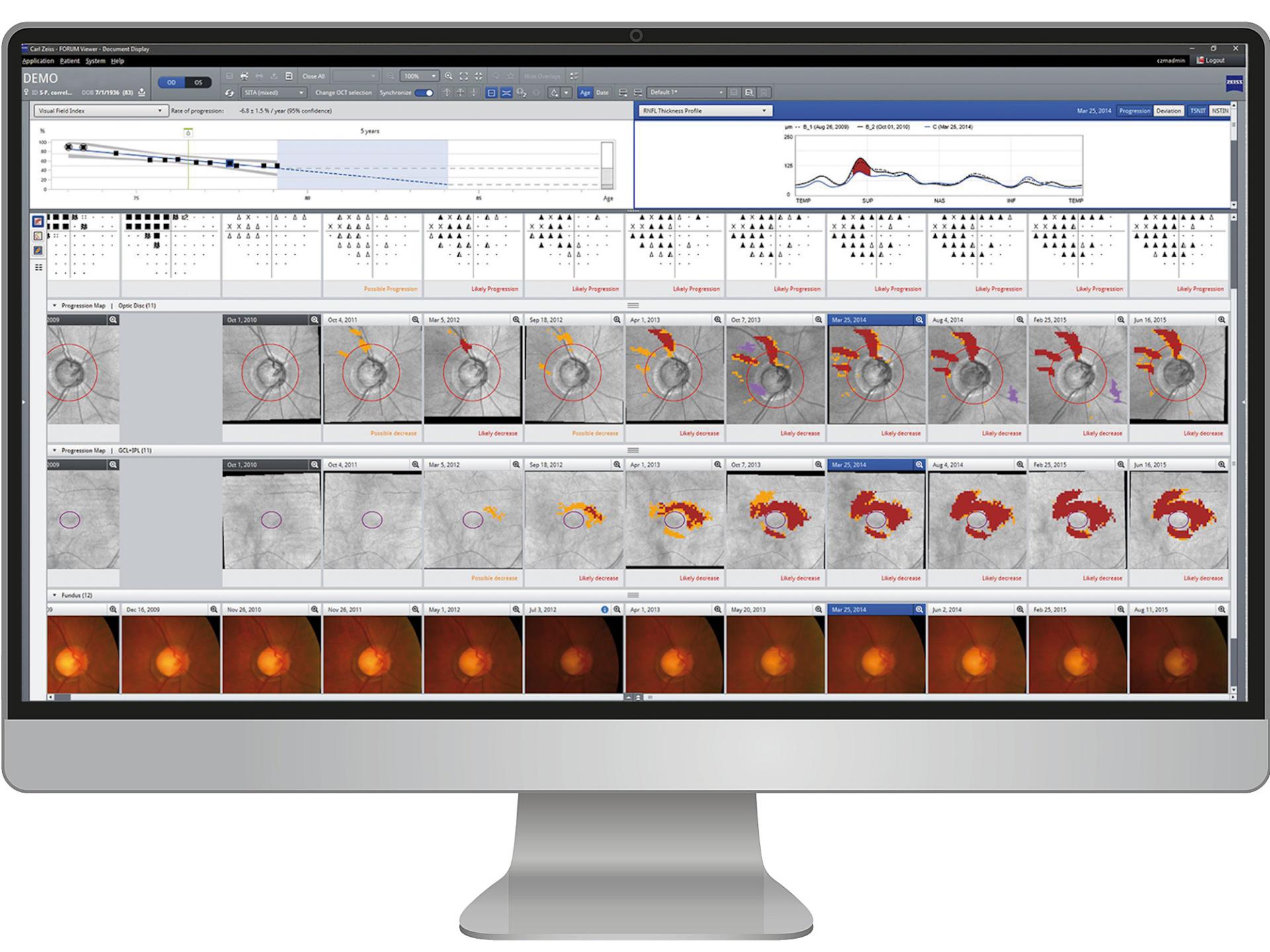 ZEISS Glaucoma Workplace