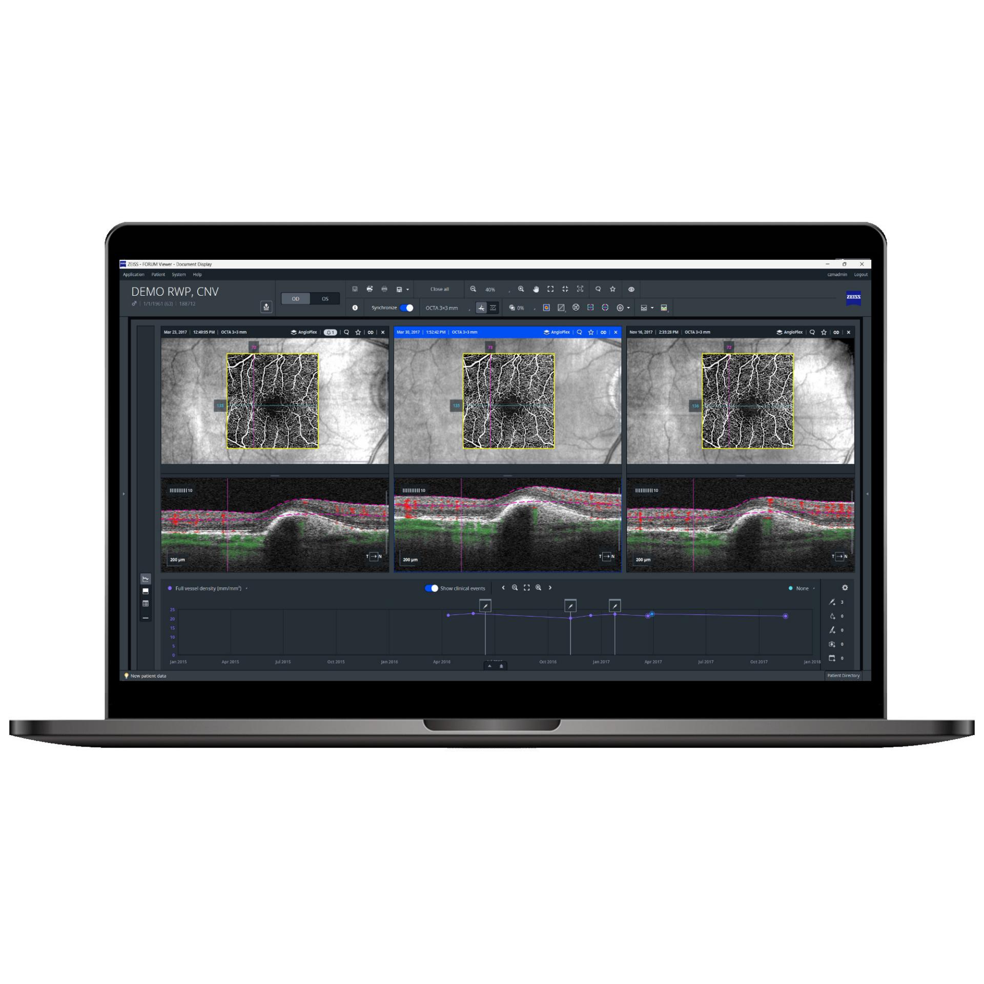 ZEISS RETINA WORKPLACE: Klarheit auf dem Weg zur Behandlung