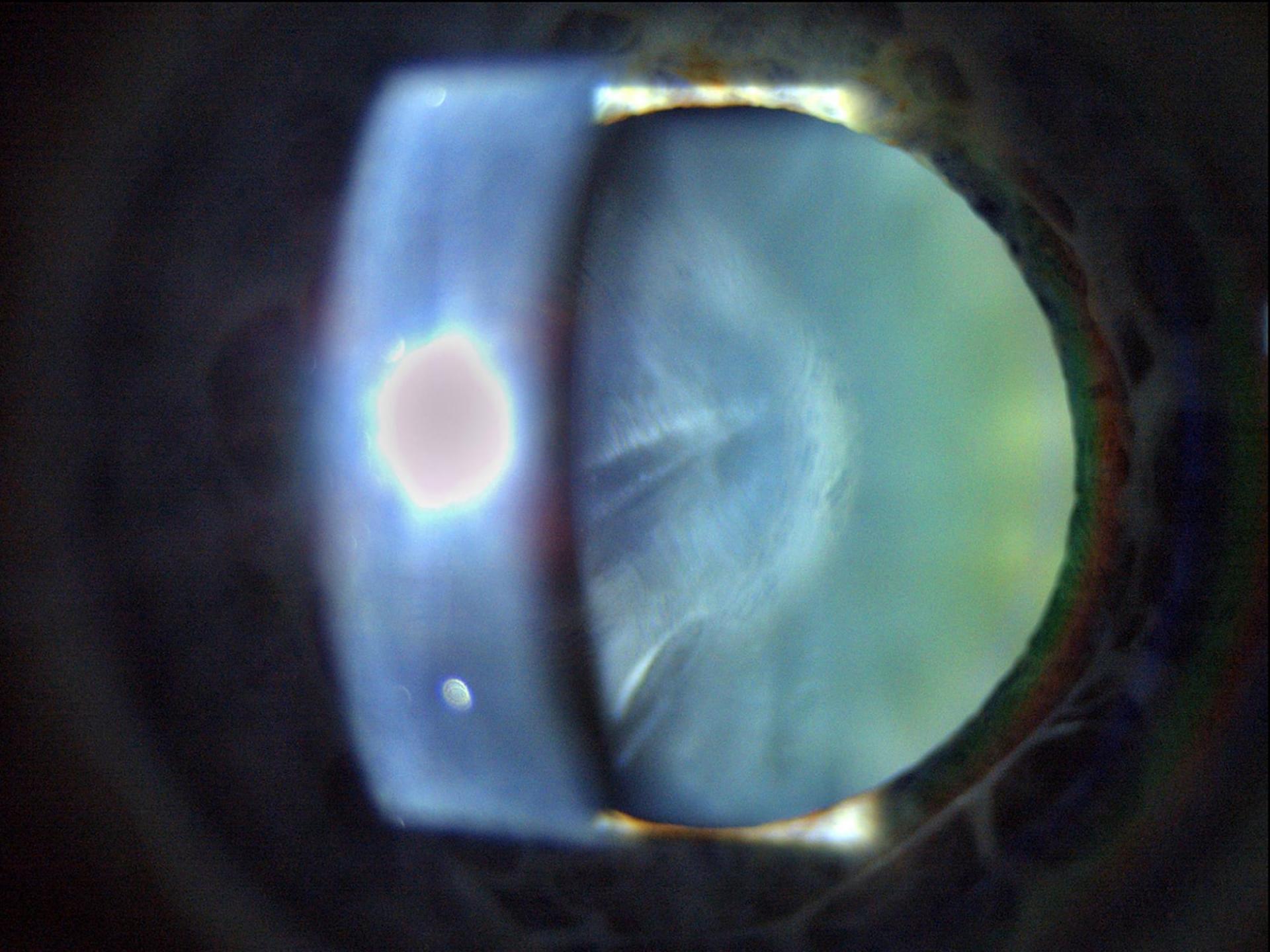 Cortical cataract
