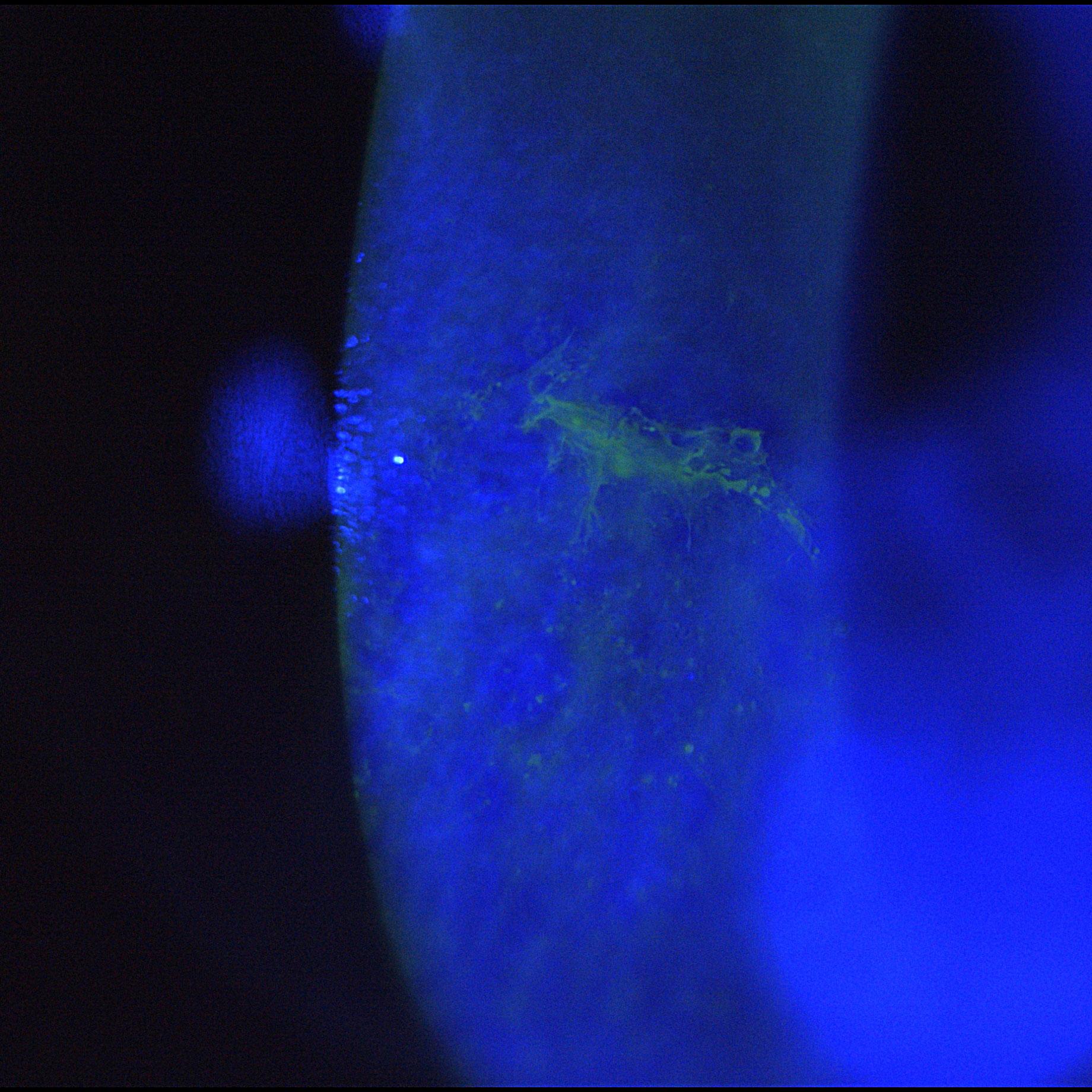 Epithelial ridge after corneal injury with fluorescein dye and blue light