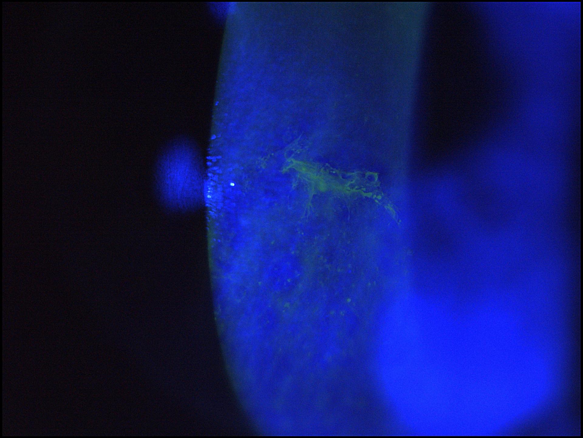 Epithelial ridge after corneal injury with fluorescein dye and blue light
