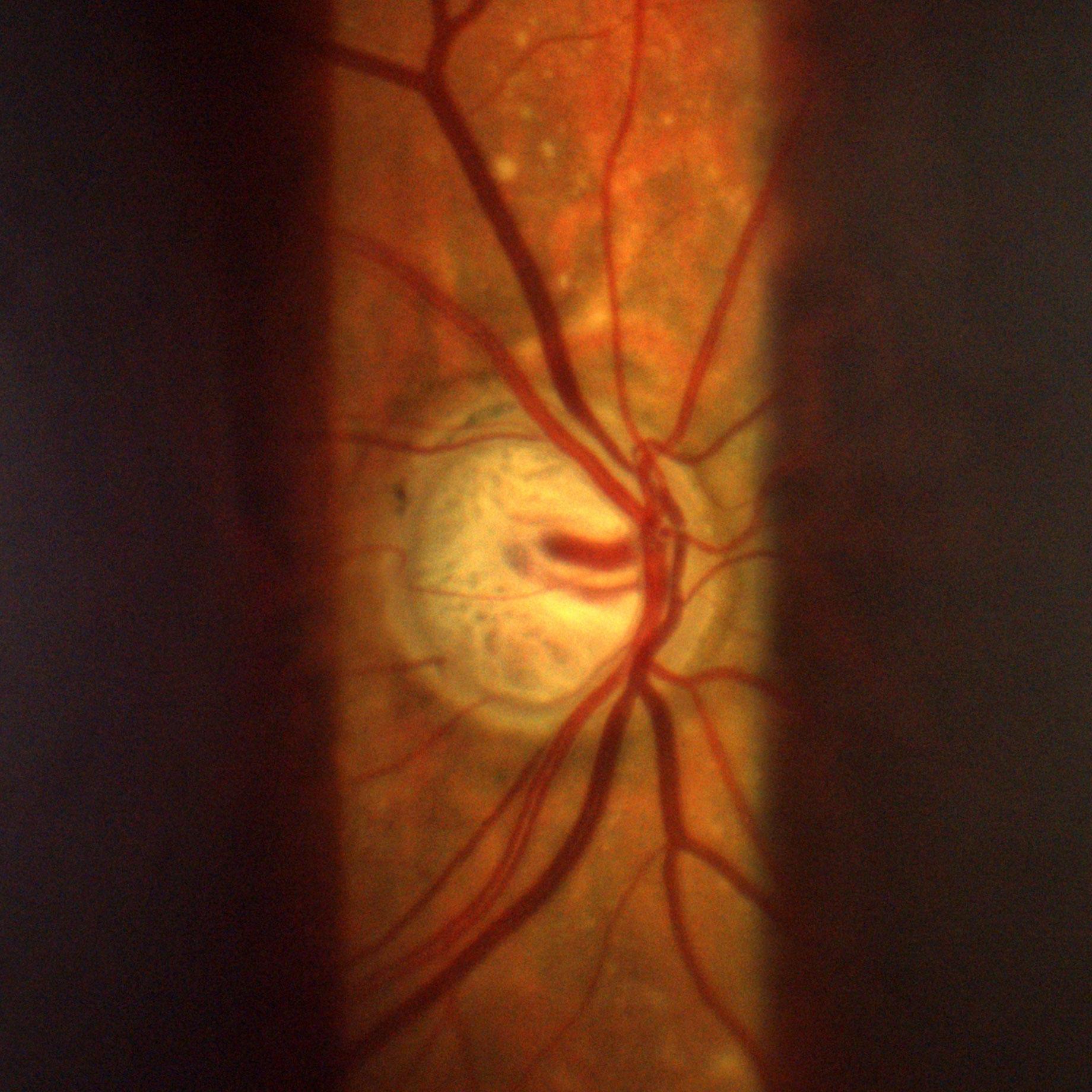 Deep excavation of optic nerve head in advanced glaucoma