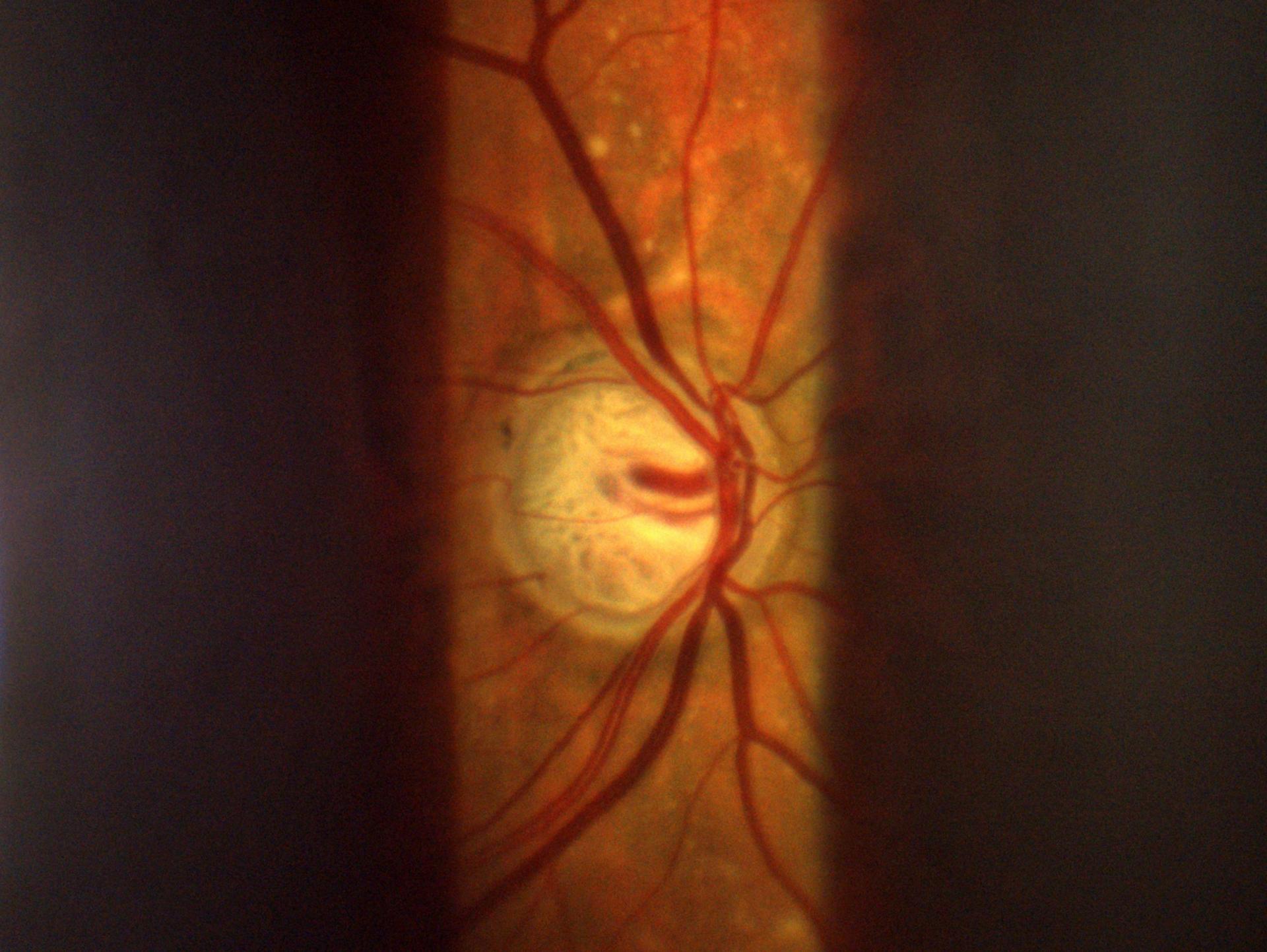 Deep excavation of optic nerve head in advanced glaucoma