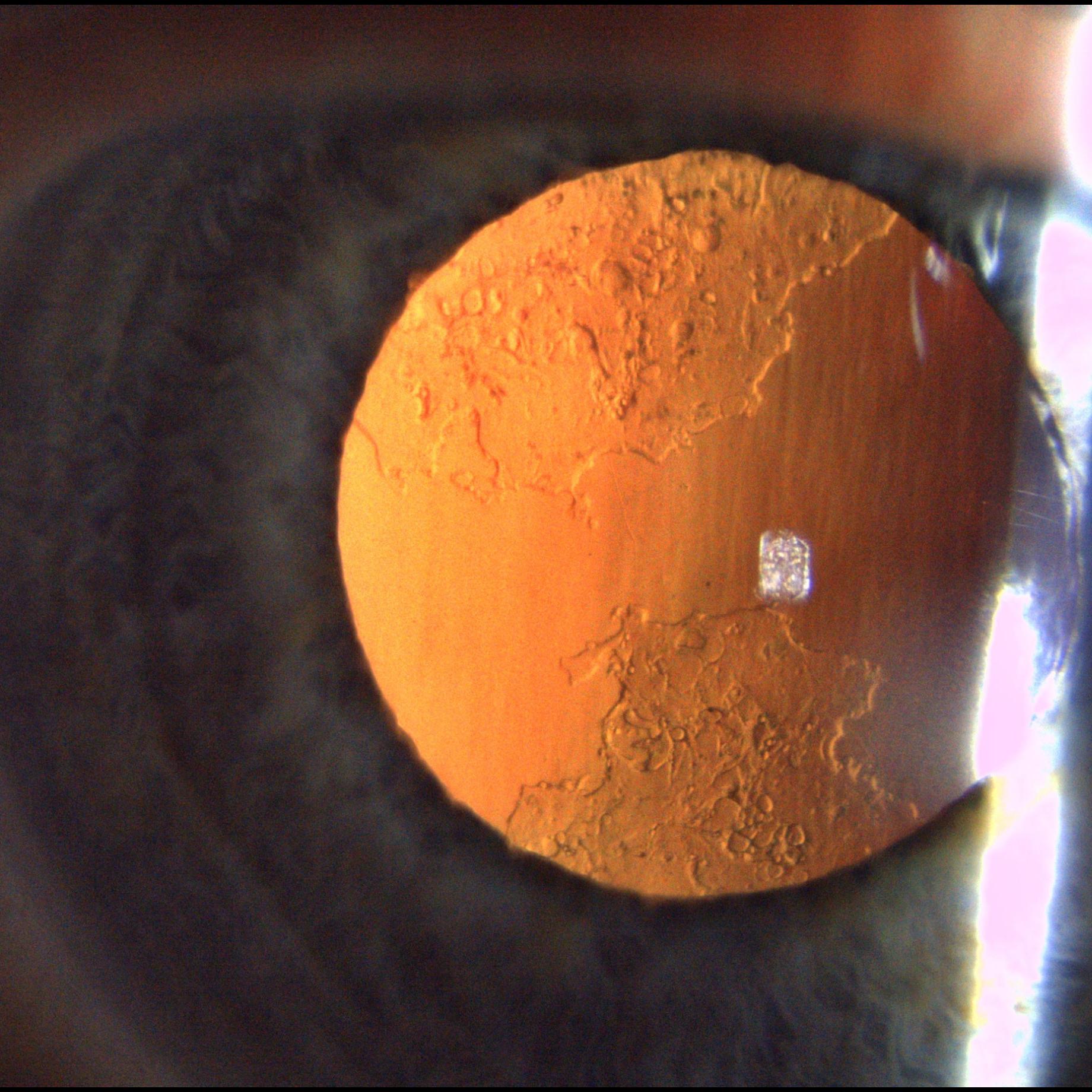 Posterior capsule opacification